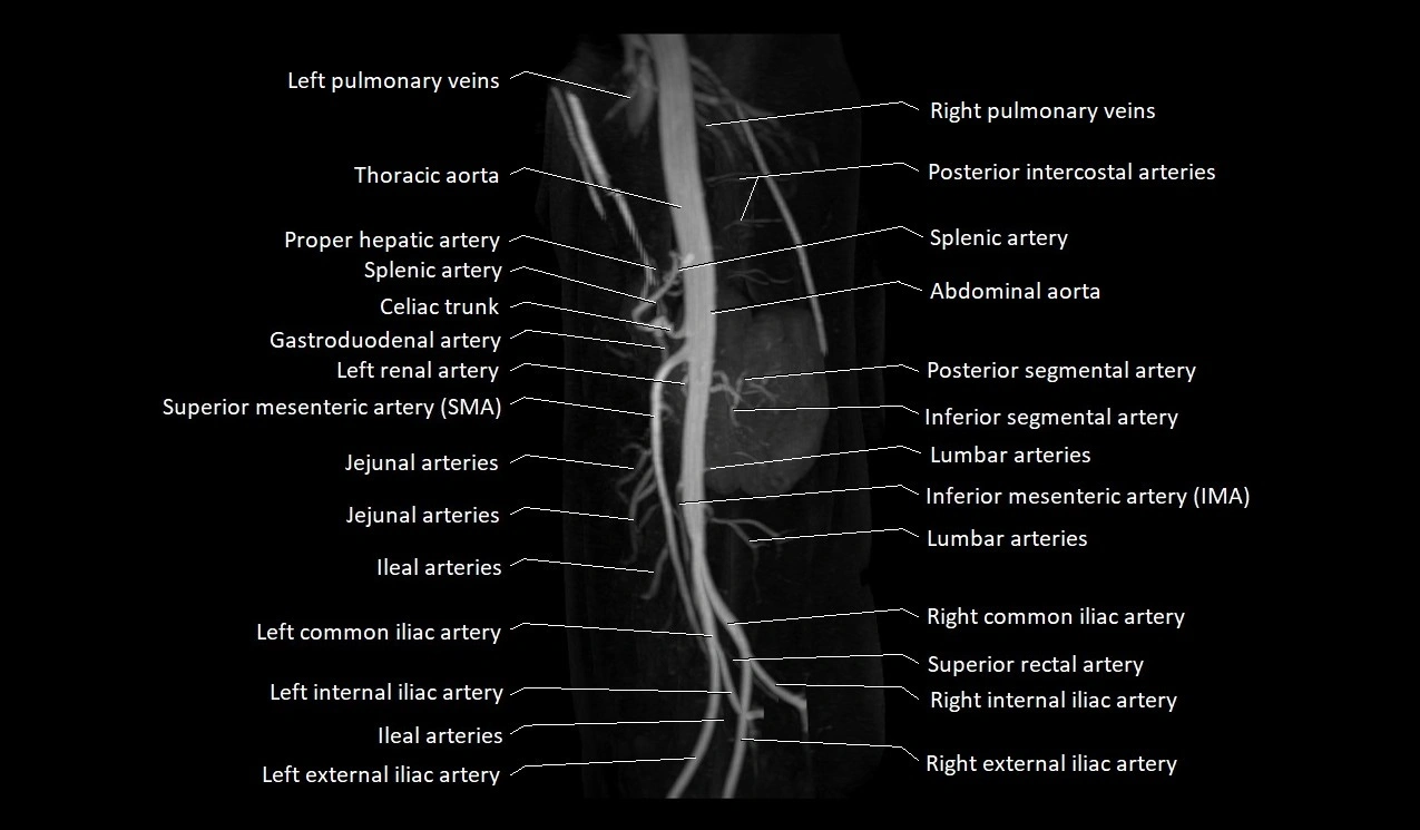 MRA abdomen (renal and mesenteric) angiography MIP 3D anatomy image 7.webp